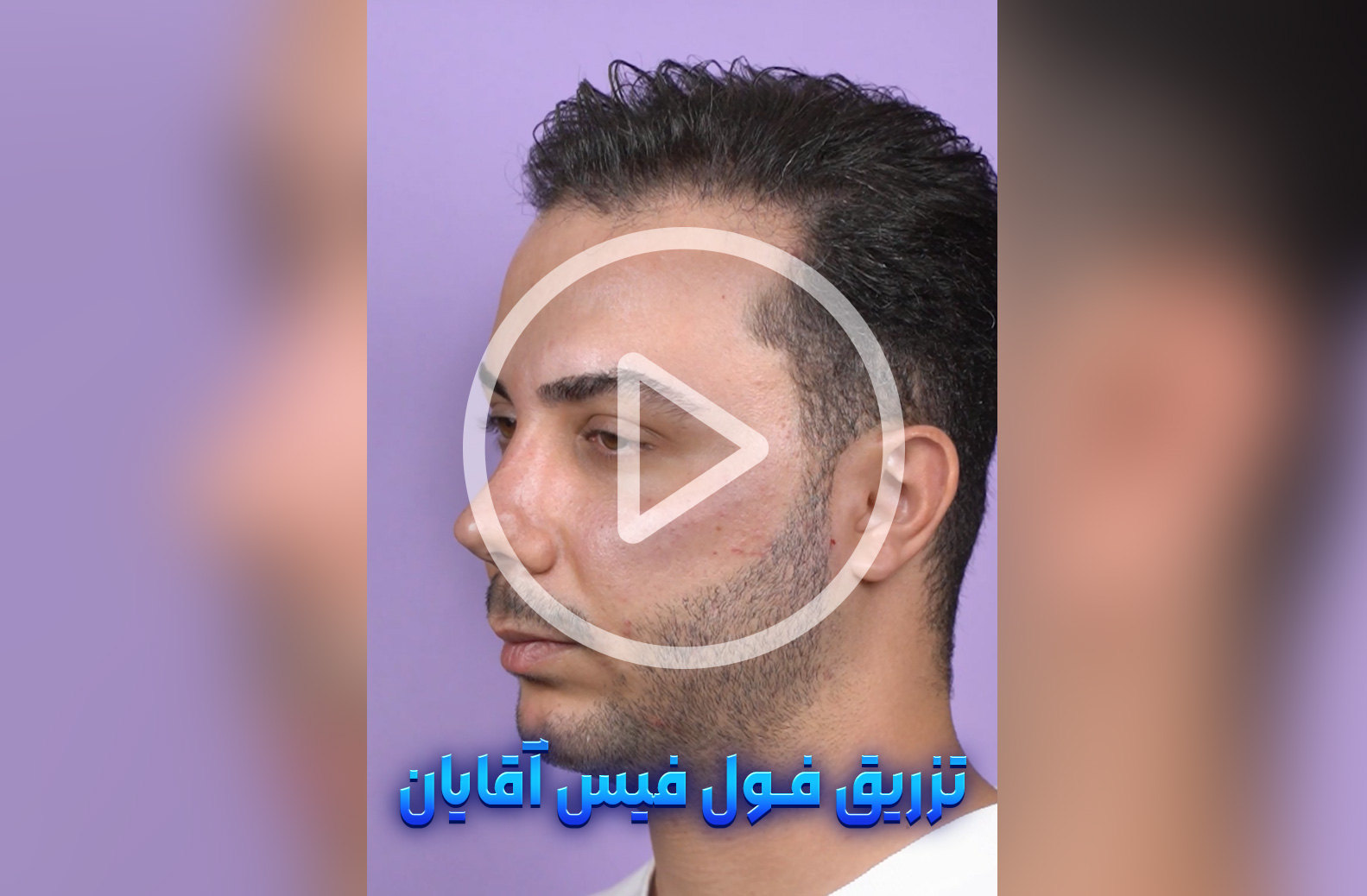 تزریق-فول-فیس-آقایان